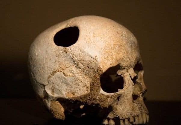 Một hộp sọ cho thấy dấu hiệu của phẫu thuật não thời La Mã cổ đại.