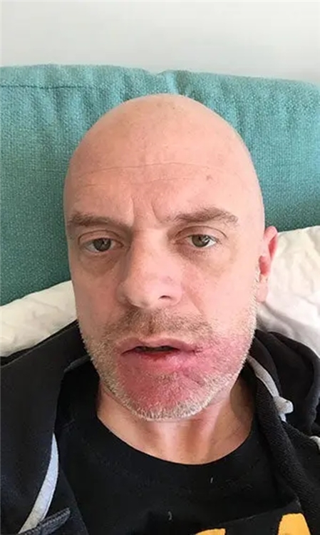 Hình ảnh Craig sau khi hóa trị và phải cắt bỏ một phần môi.