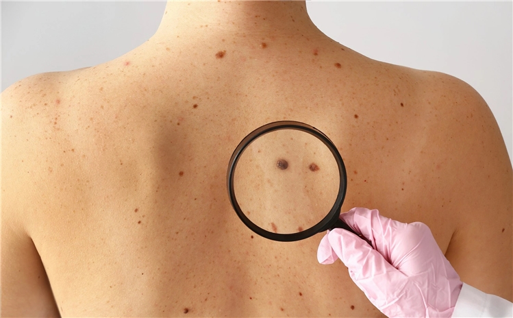 skin cancer